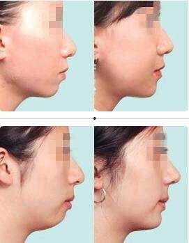 下巴后缩明星,独特魅力背后的故事